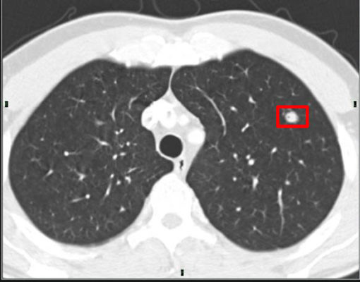 What Do Lung Nodules Look Like On Ct Scan