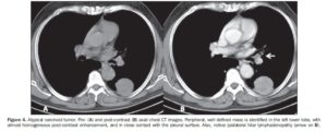 atypical-lung-cancer